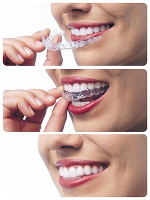 Invisalign-Trays