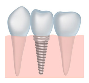 hernando dental implants