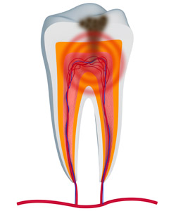 root canal therapy hernando, MS